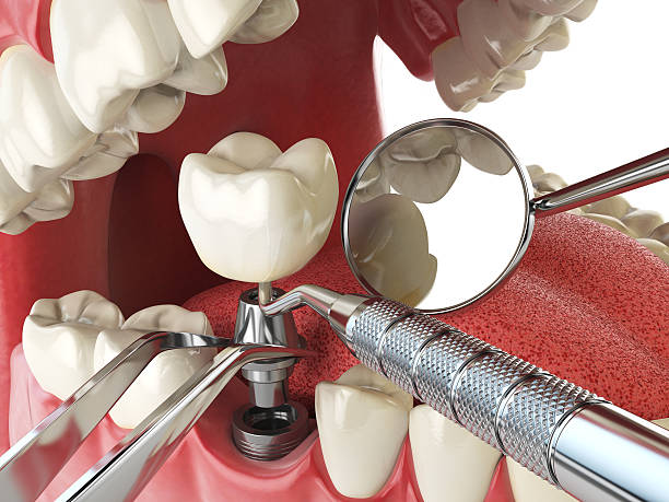 Best Emergency Wisdom Teeth Removal in Meadville, PA